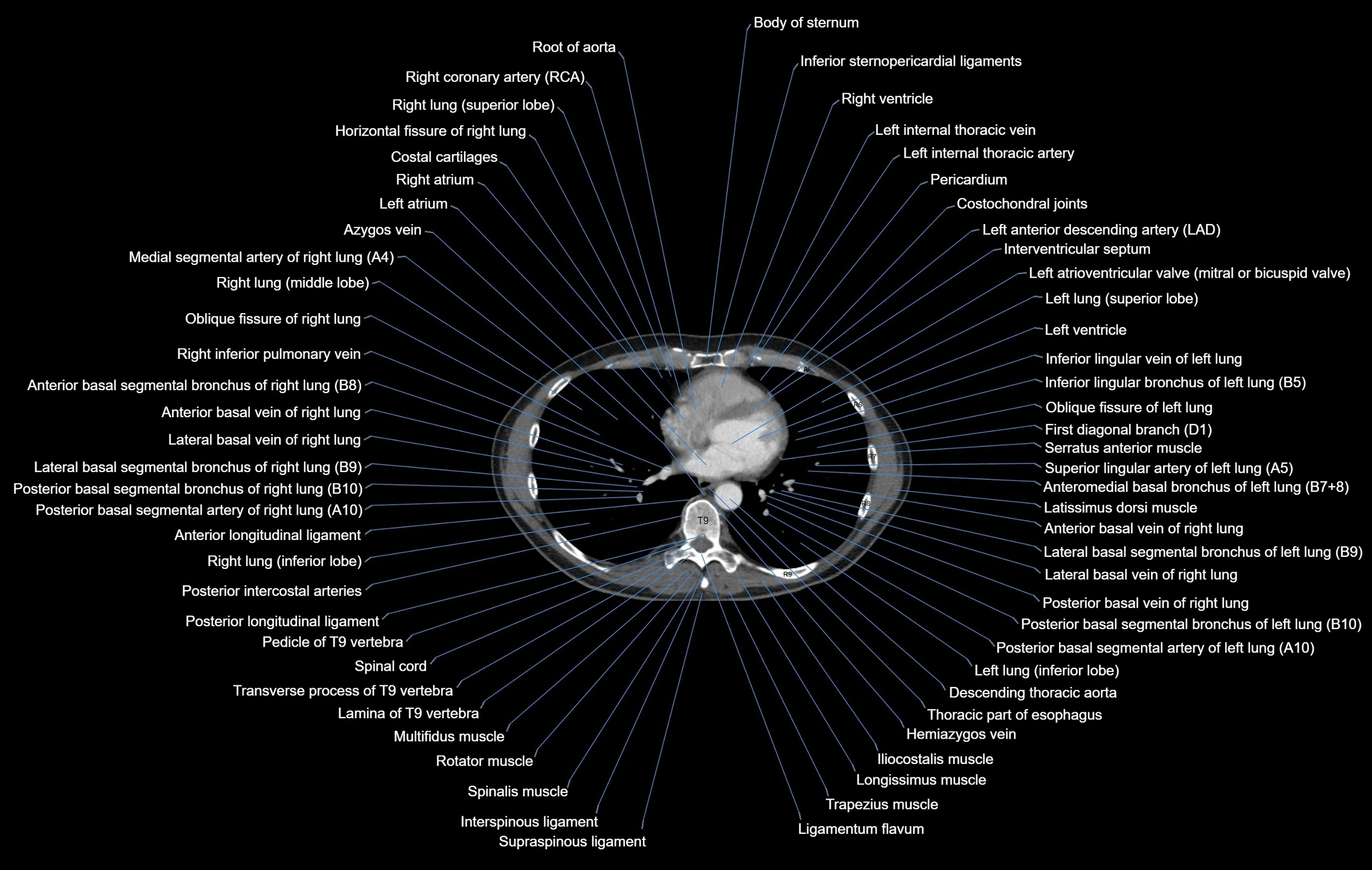 CT chest (thorax) labelled axial cross sectional anatomy radiology image-00078.webp